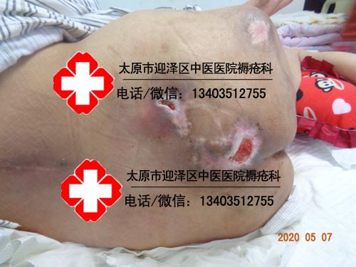 中药硬膏贴敷消肿止痛有妙招(图1)